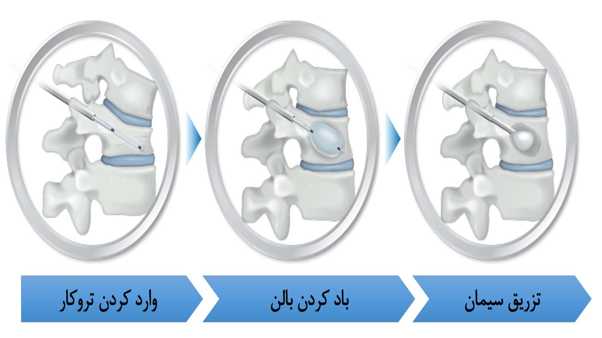 مراحل استفاده از ست ابزار کایفوپلاستی برای ترمیم شکستگی مهره ها